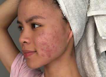 Liz – Chronic cystic acne